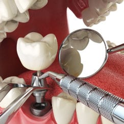 Close-up of dental tools examining a newly placed dental implant